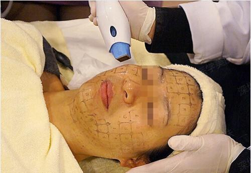 電波拉皮治療怎么樣才有效？